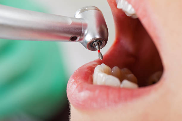 Best Emergency Root Canal Treatment in Shell Lake, WI